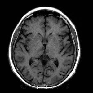Axial t1 sin contraste: compromiso talamico bilateral por dos imagenes hipointensas con ligero efecto de masa sobre el iii ventriculo.