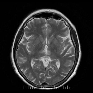 Axial t2: igual hallazgo que en t1 observandose hiperintensas en la actual secuencia.
