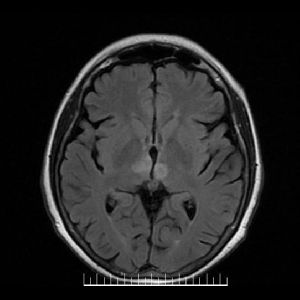 Axial flair: las imagenes descriptas conservan la hiperintensidad en esta secuencia pudiendo indicar edema celular
