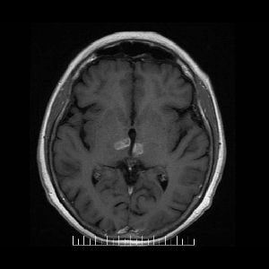 Axial t1 con contraste: refuerzo periferico de las imagenes descriptas que se observa frecuentemente en lesiones de tipo isquemico agudo.