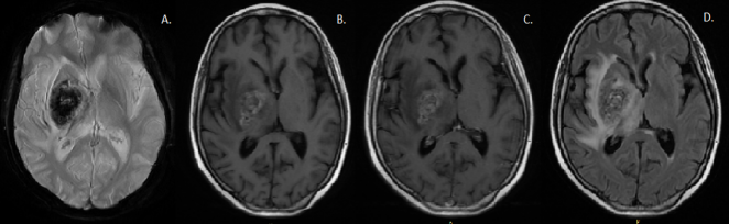 Lesi&oacute;n lenticulo insular y temporal derecha con efecto de masa que se observa predominantemente hipointensa en GRE (A). Comparando T1 (B) y T1 con gadolinio, se destaca el ligero realce tras la administraci&oacute;n de contraste (c). T2 flair muestra se&ntilde;al heter