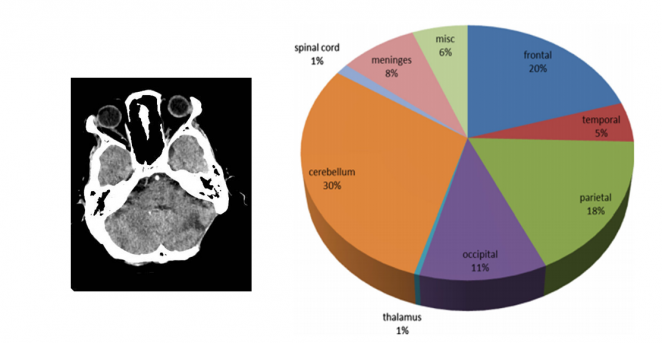 Paknesan S. et al. Brain metastases from ovarian cancer: a systematic review. J Neurooncol. 2014,Aug;119(1):1-6.